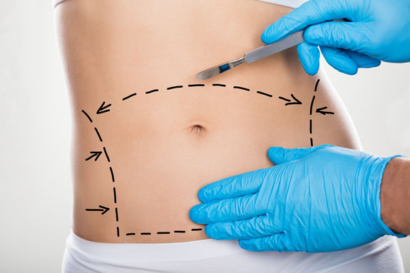 Abdominoplastik Erlangen